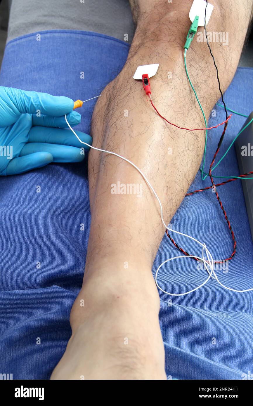 Électromyographie EMG et Somatosensory potentiel évoqué de la VEP des membres inférieurs, test neurophysiologique applique des stimuli électriques près des nerfs Banque D'Images