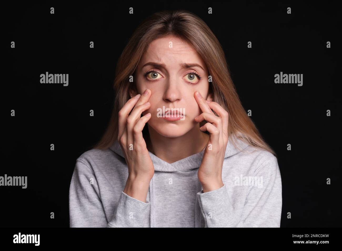 Femme vérifiant son état de santé sur fond noir. Yeux jaunes comme symptôme de problèmes avec le foie Banque D'Images