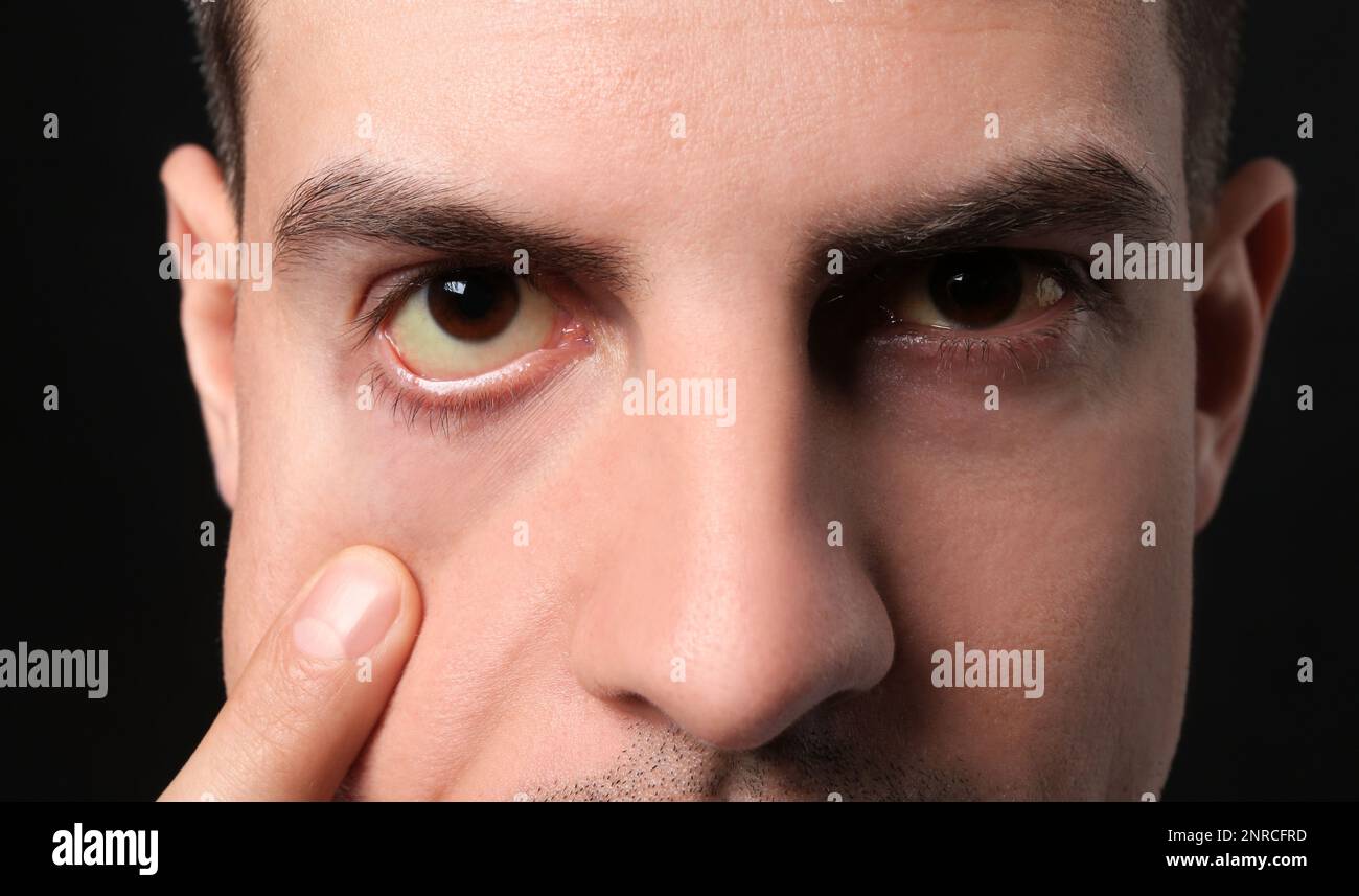 Homme vérifiant son état de santé sur fond noir, gros plan. Yeux jaunes comme symptôme de problèmes avec le foie Banque D'Images
