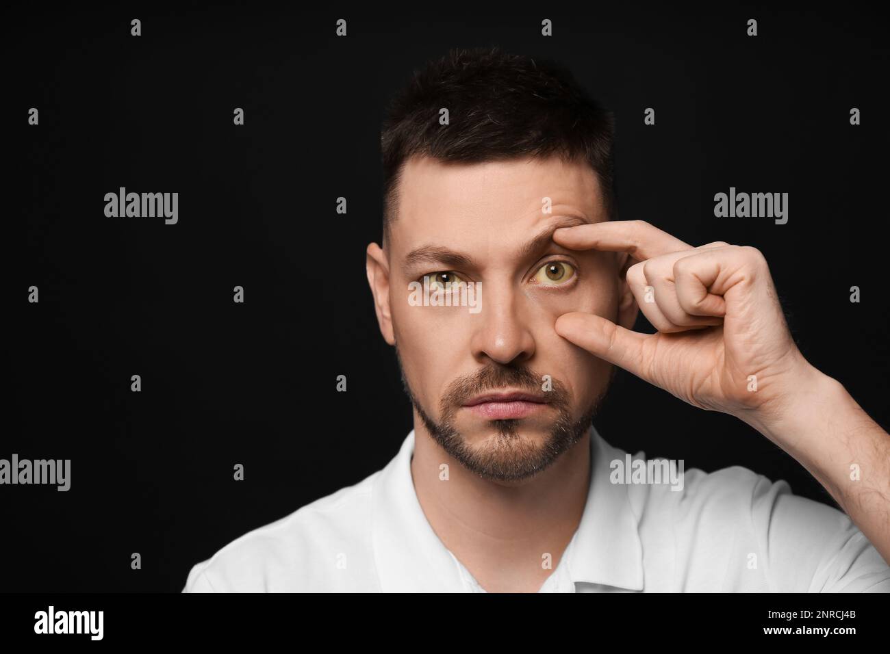 Homme vérifiant son état de santé sur fond noir, espace pour le texte. Yeux jaunes comme symptôme de problèmes avec le foie Banque D'Images
