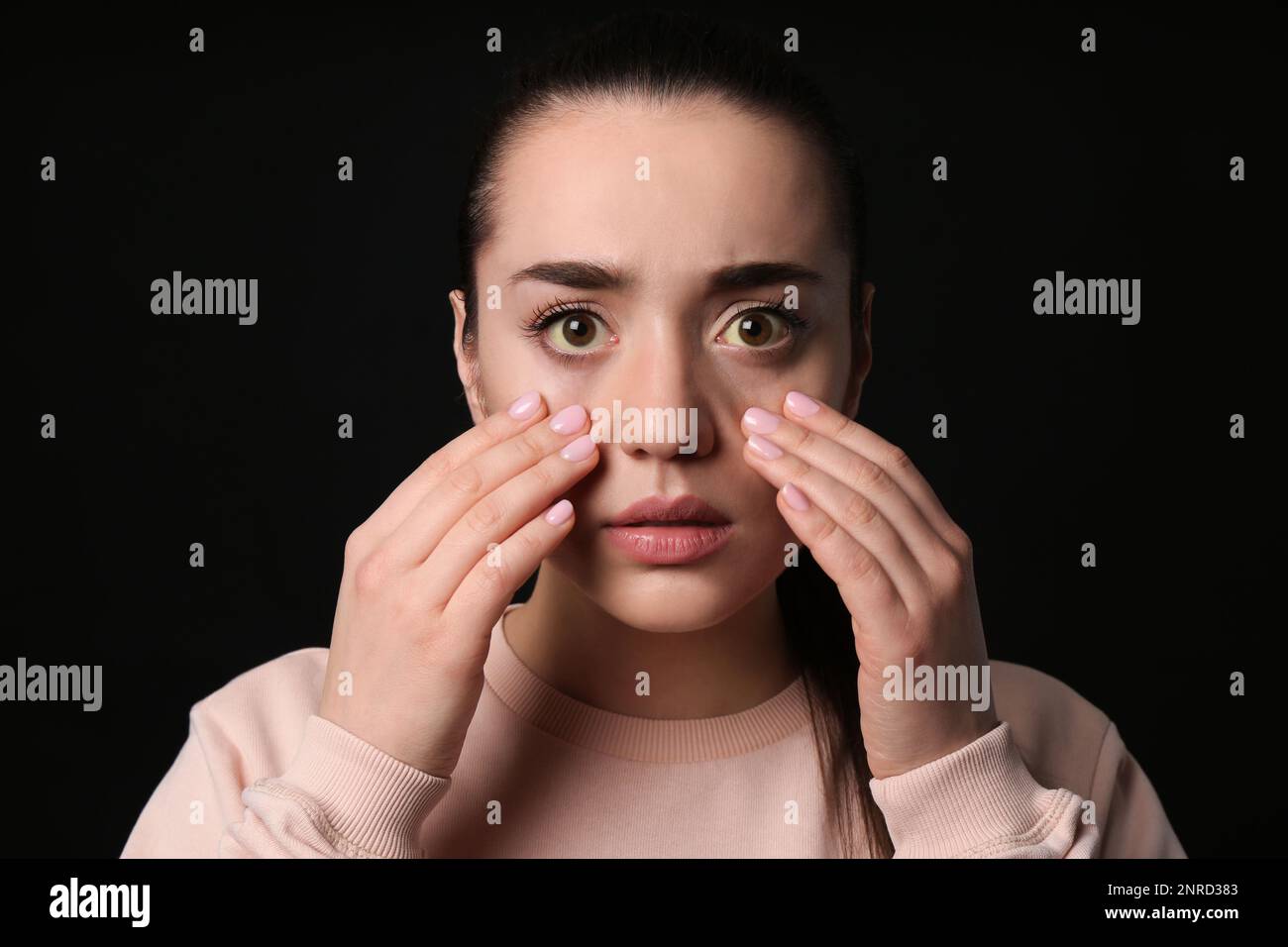 Femme vérifiant son état de santé sur fond noir. Yeux jaunes comme symptôme de problèmes avec le foie Banque D'Images