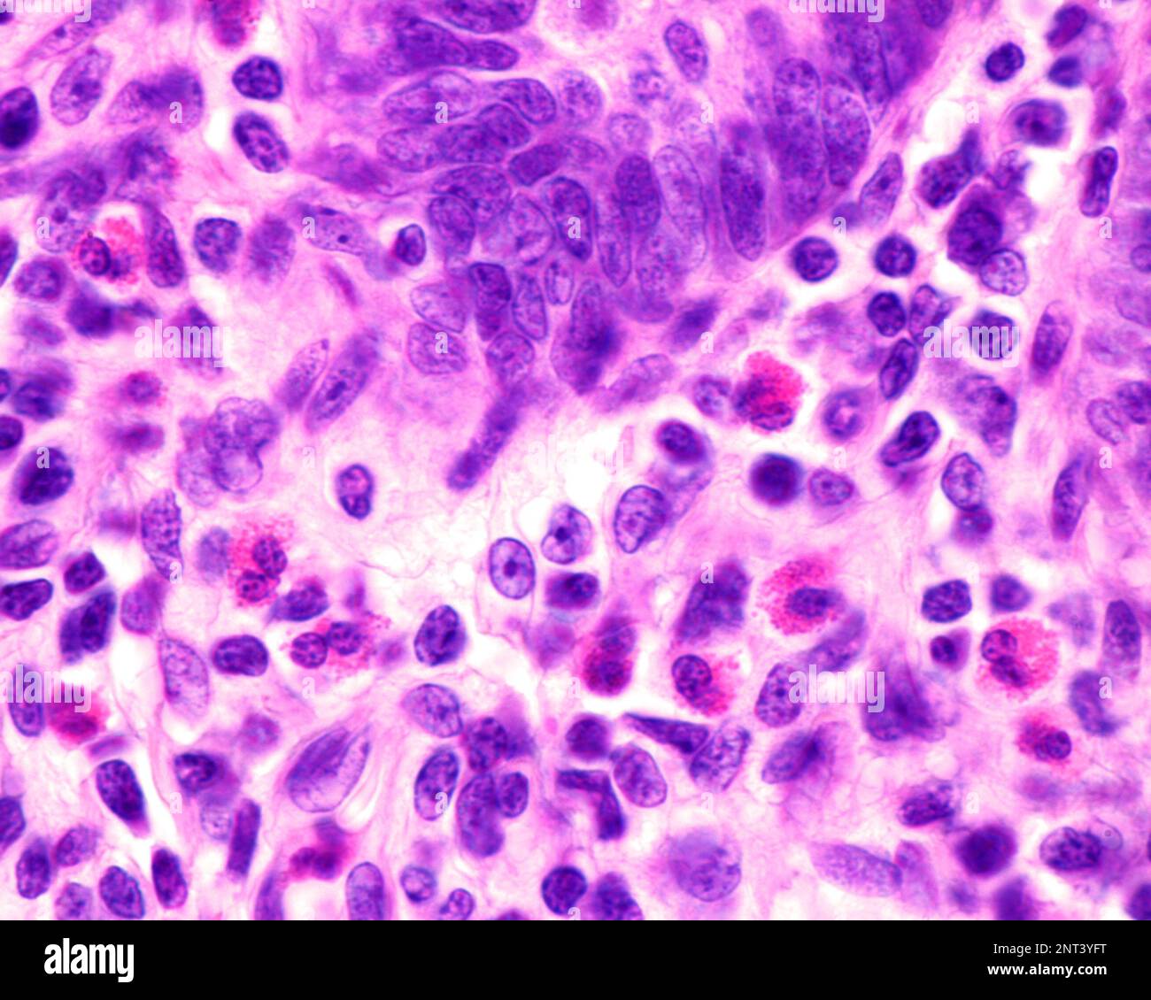 Micrographe au microscope léger montrant les granulocytes éosinophiles dans la lamina propria d'un appendice enflammé. Ces cellules contiennent des granules rouges abondants ( Banque D'Images