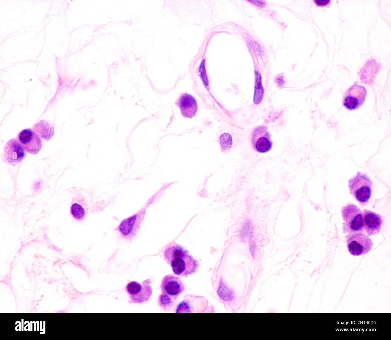 Les cellules plasmatiques sont des lymphocytes B activés par la présence d'antigènes qui sécrètent de grandes quantités d'anticorps. Ils apparaissent dans les tissus affectés par c Banque D'Images