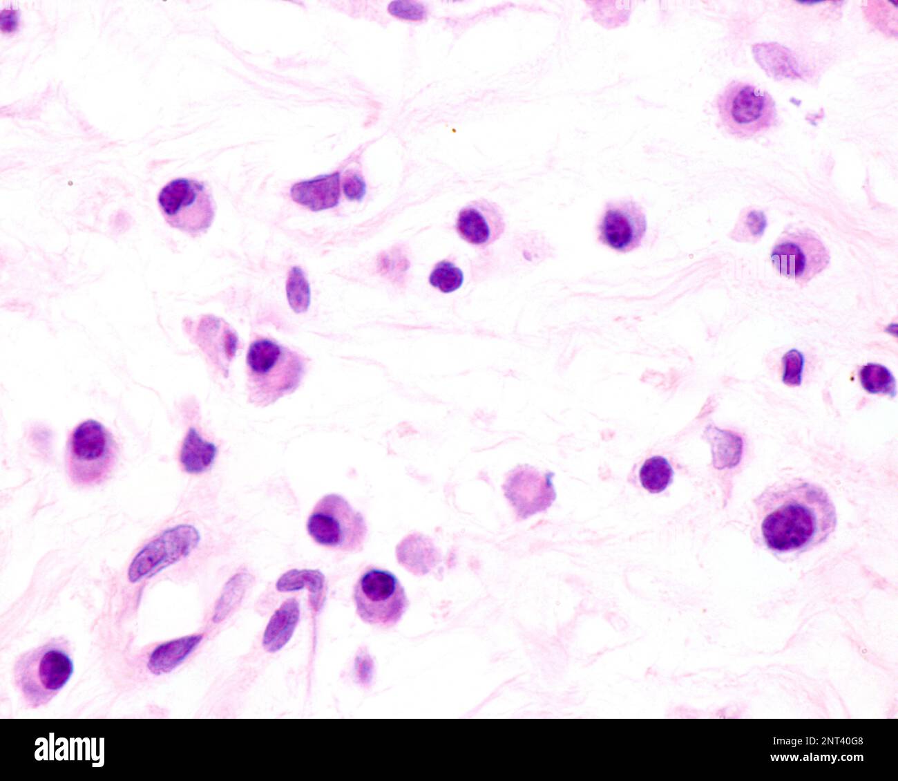 Les cellules plasmatiques sont des lymphocytes B activés par la présence d'antigènes qui sécrètent de grandes quantités d'anticorps. Ils apparaissent dans les tissus affectés par c Banque D'Images