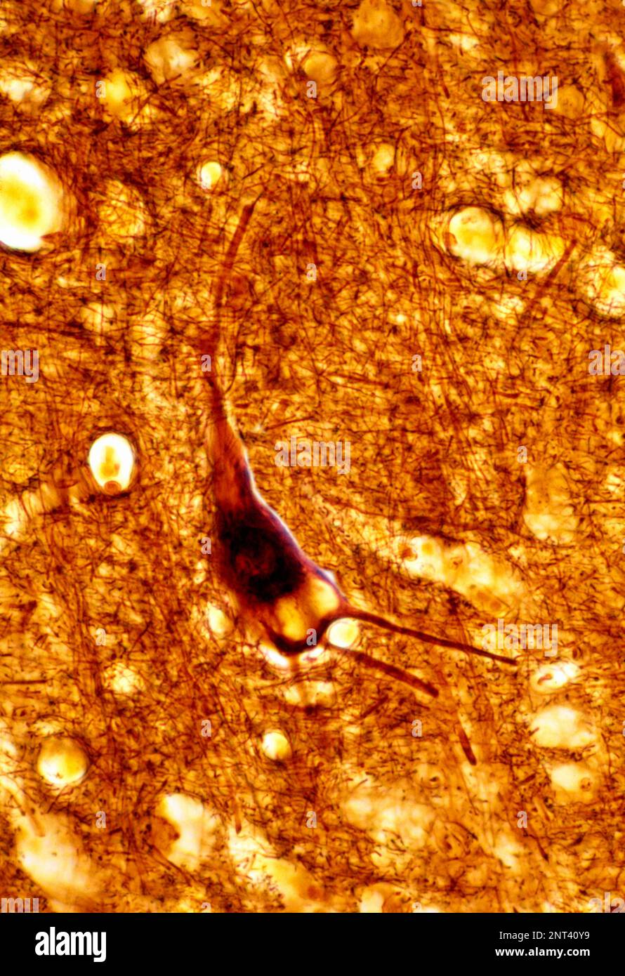 Micrographe léger d'un cortex cérébral humain d'un cerebrum sénile, coloré avec une méthode de l'argent, montrant un grand dépôt de lipofuscine dans un n pyramidal Banque D'Images