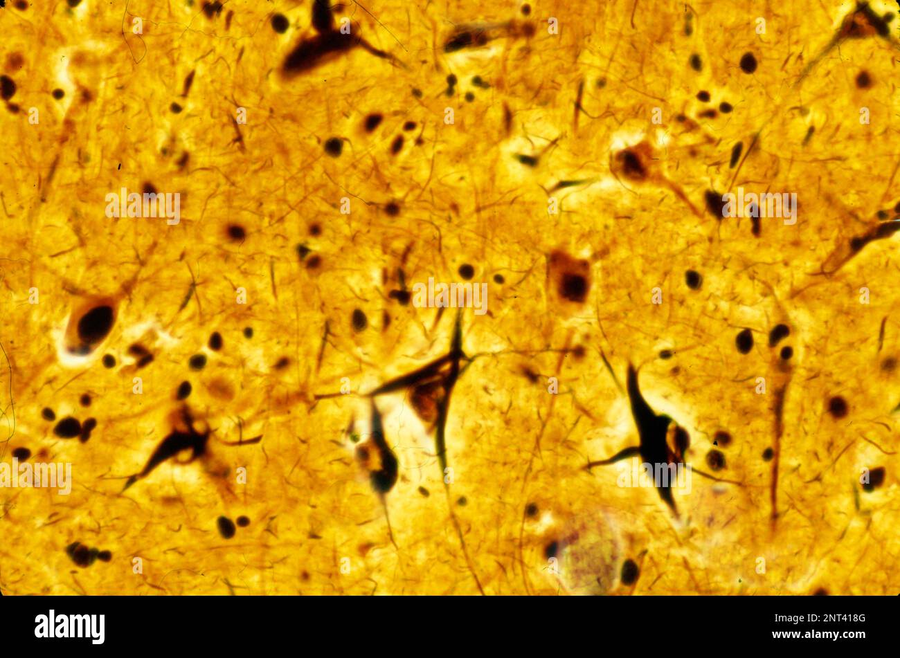 Micrographe léger d'un cortex cérébral humain montrant des enchevêtrements neurofibrillaires dans plusieurs neurones pyramidaux. Les enchevêtrements neurofibrillaires (TNF) sont un acte charant Banque D'Images