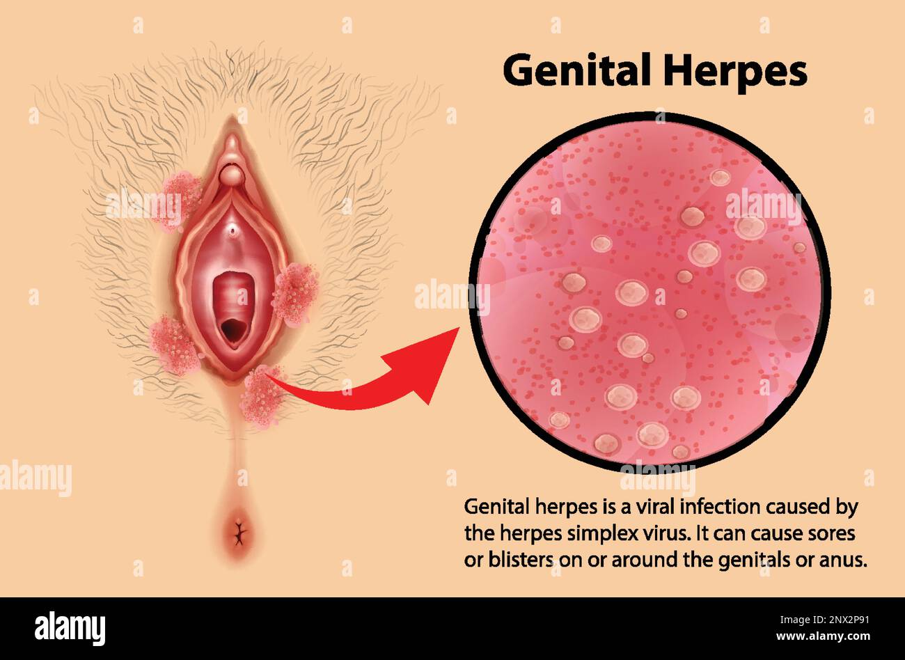 Infographie sur les herpès génital avec illustration explicative ...