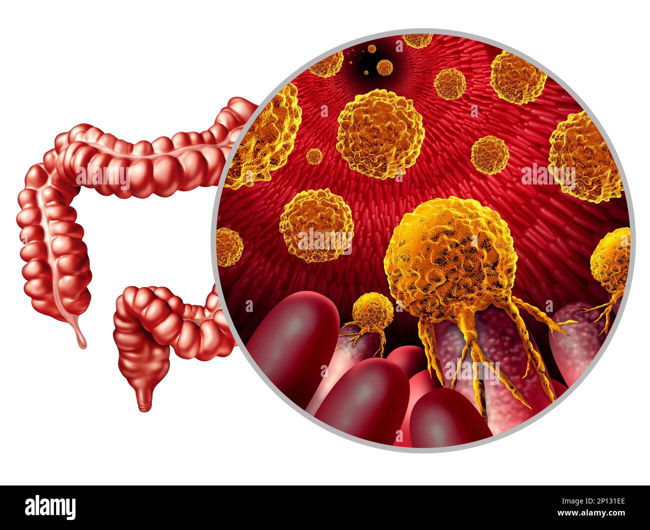 Croissance du cancer du côlon ou tumeur maligne colorectal concept comme illustration médicale d'un gros intestin avec une maladie carcinogène métastatique Banque D'Images