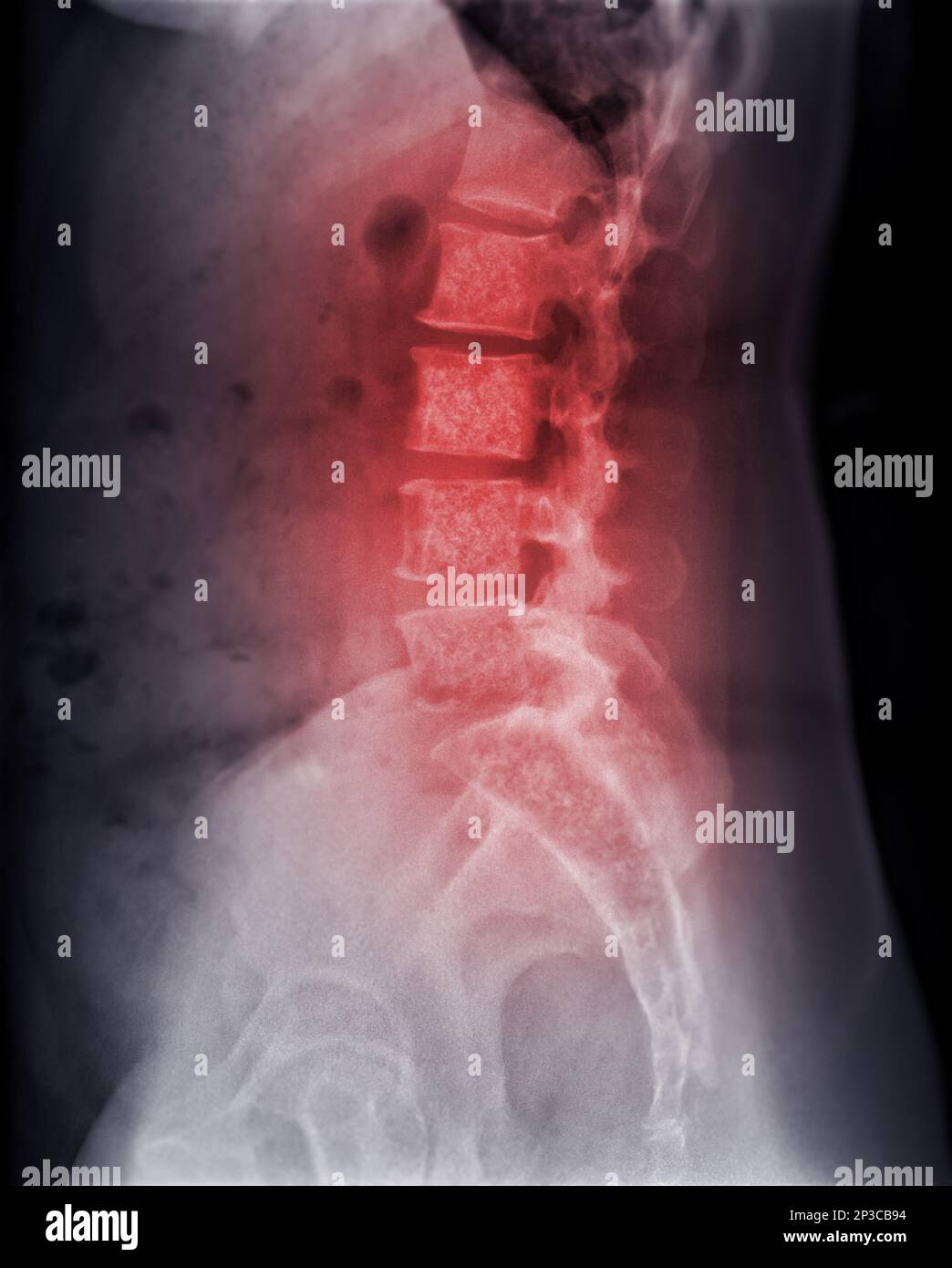 Image radiographique du rachis lambosacral ou du rachis L-S montrant des métastases osseuses . Banque D'Images