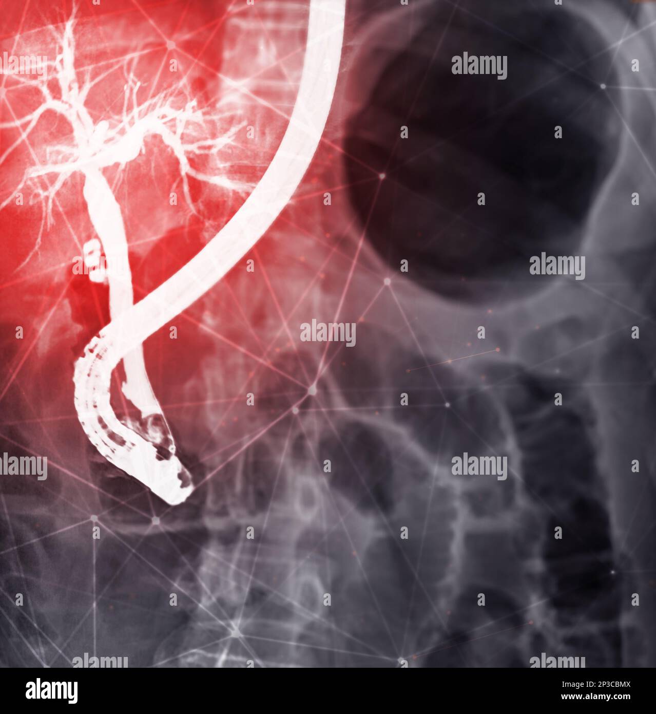 Image radiographique de l'endoscopie après Doctor Doing ERCP et