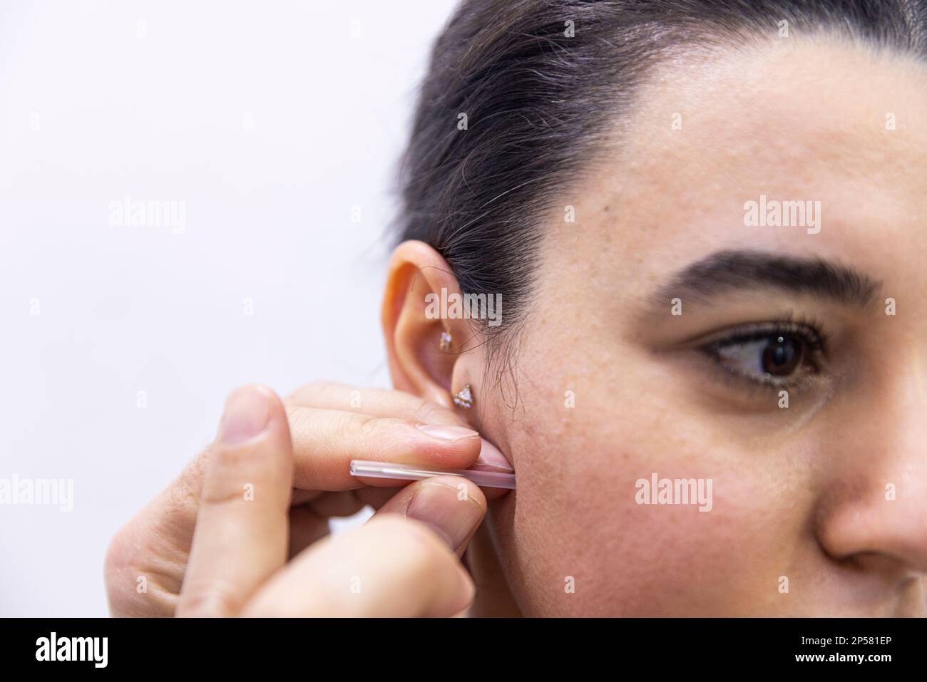 Traitement de l'aiguille sèche. Un portrait d'une petite aiguille d'acupuncture qui colle dans le visage d'une personne à côté du nez, pour guérir la douleur, soulager le stress ou un autre M. Banque D'Images