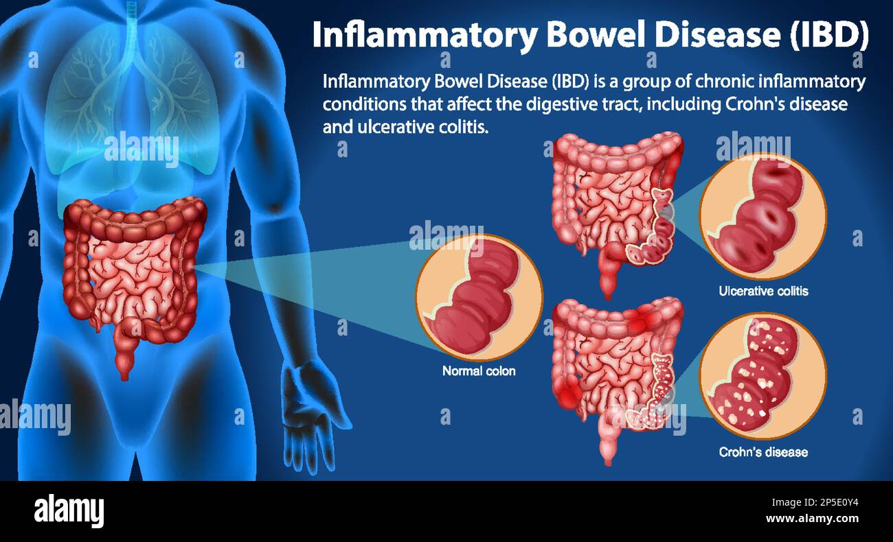 Illustration infographique des maladies inflammatoires de l'intestin (MII) Illustration de Vecteur