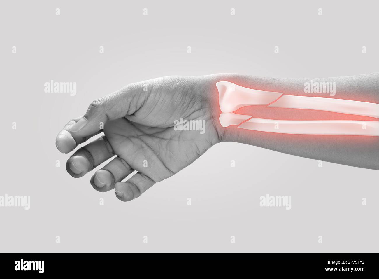 Les hommes présentant un risque plus élevé de fractures du poignet. Concept de douleur Banque D'Images
