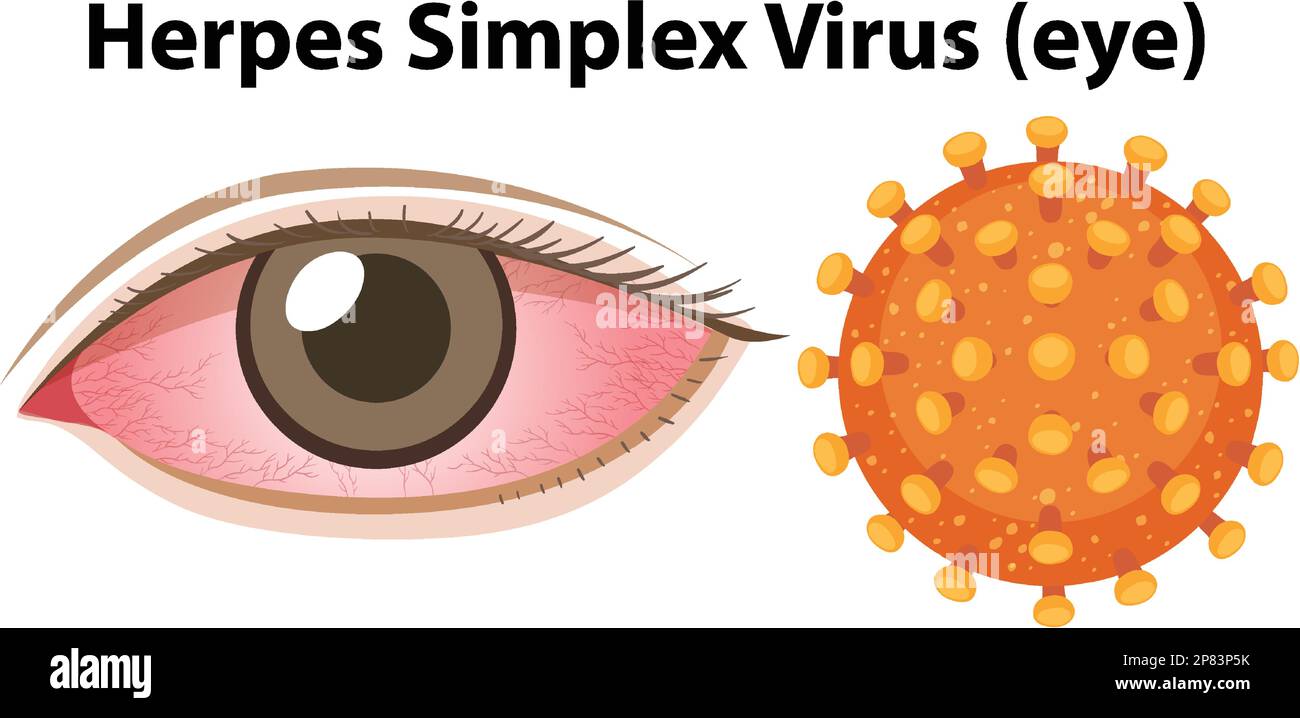 Illustration du virus de l'herpès simplex (œil) Illustration de Vecteur