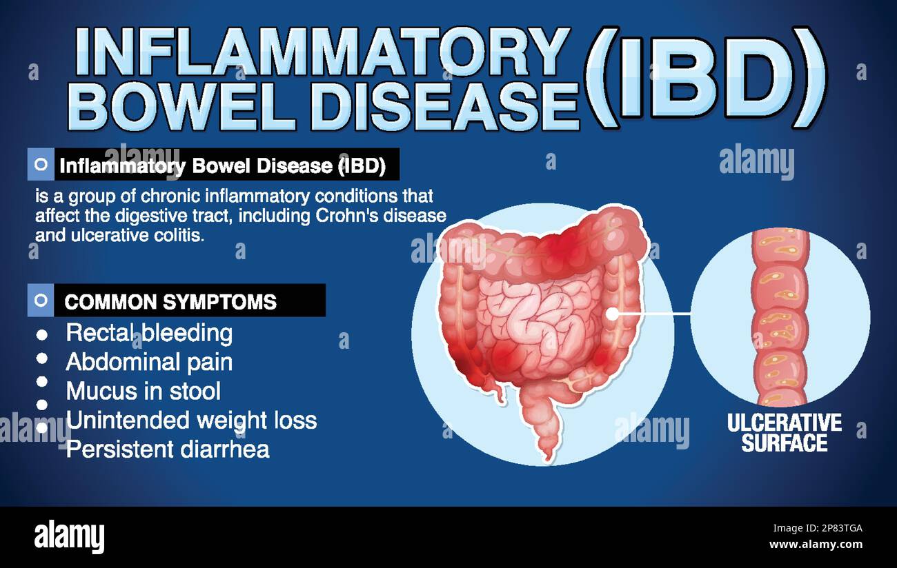Illustration infographique des maladies inflammatoires de l'intestin (MII) Illustration de Vecteur