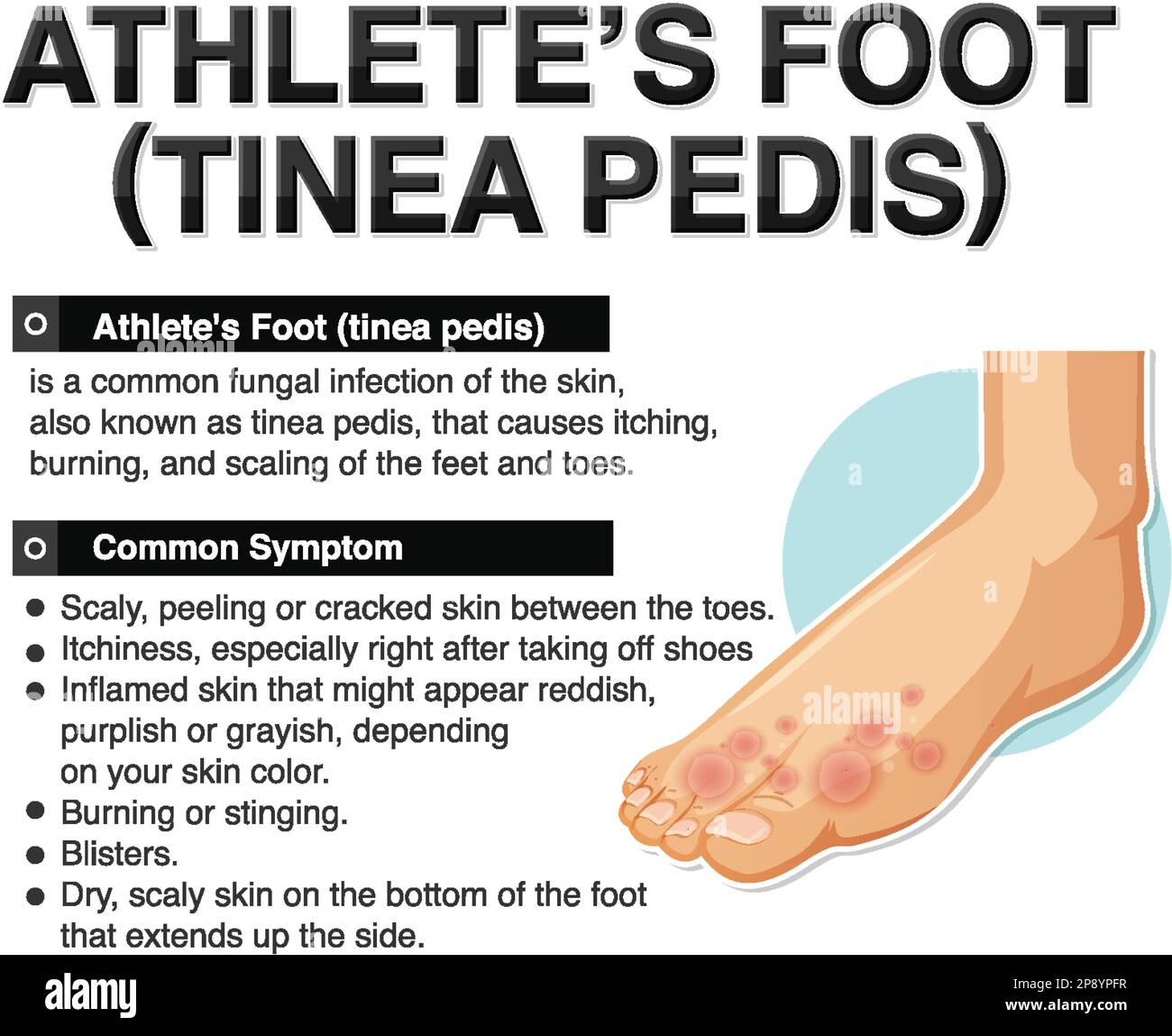 Affiche informative sur l'illustration du pied de l'athlète Illustration de Vecteur