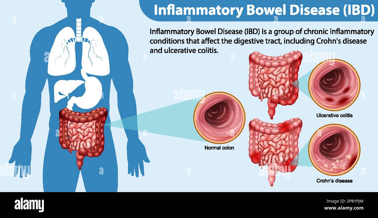 Illustration infographique des maladies inflammatoires de l'intestin (MII) Illustration de Vecteur