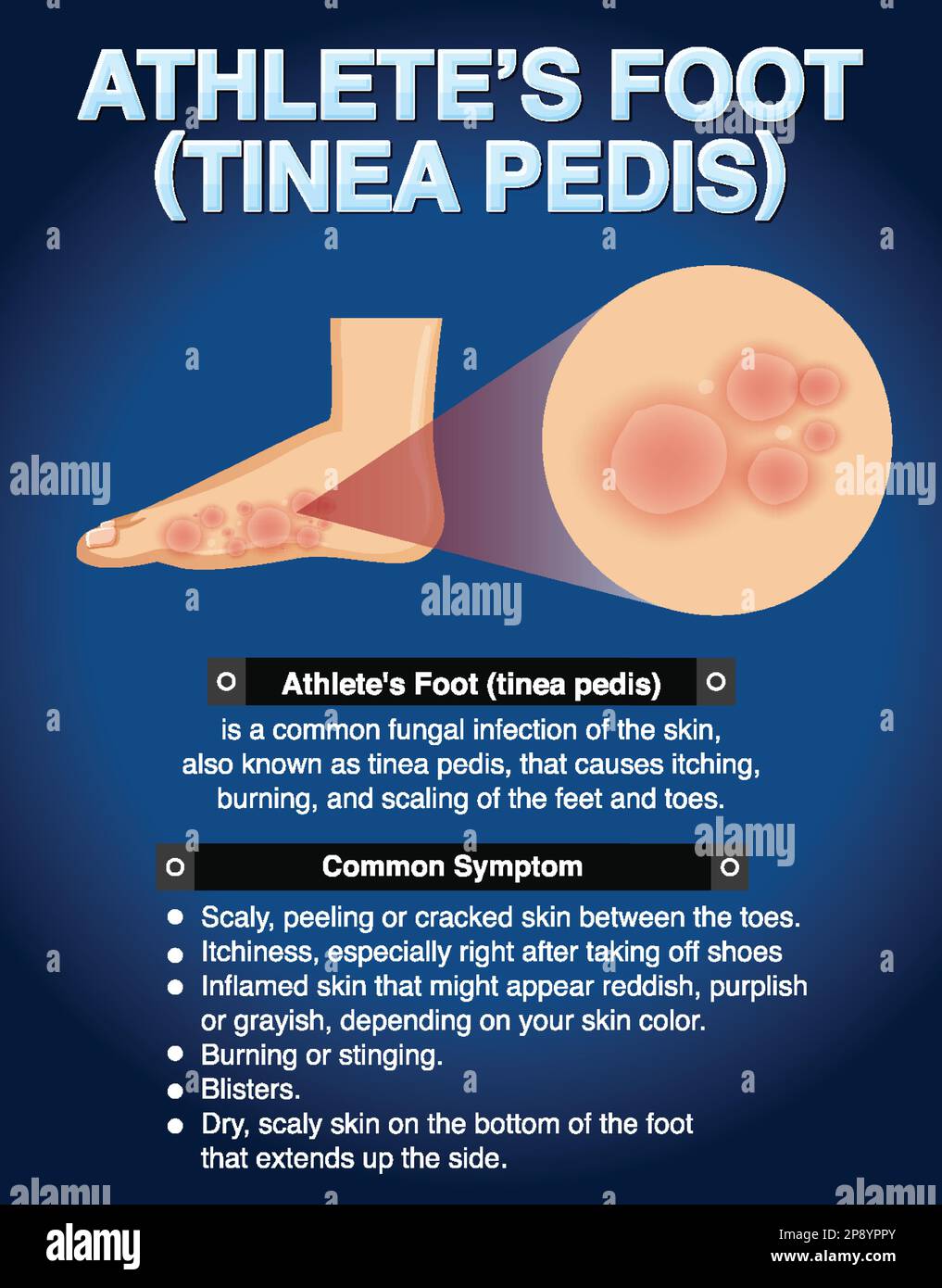 Affiche informative sur l'illustration du pied de l'athlète Illustration de Vecteur