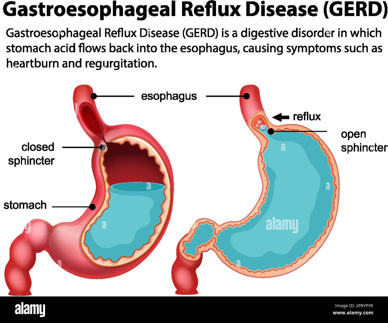 Illustration du schéma de la maladie de reflux gastro-œsophagien ...