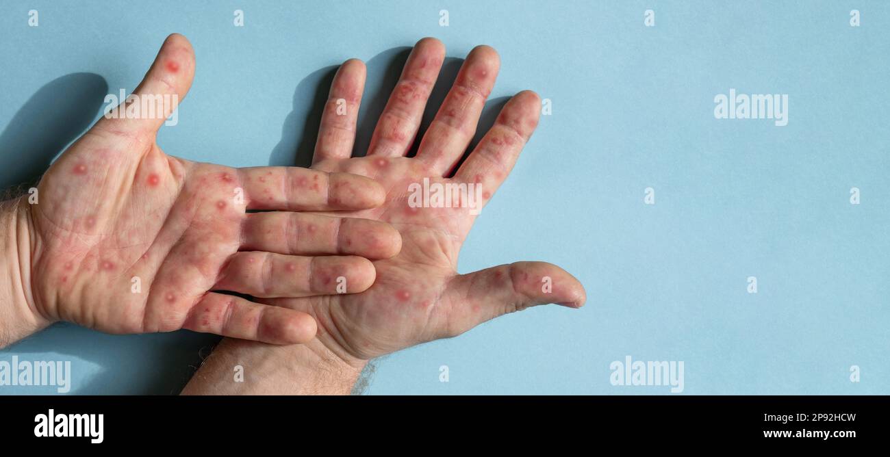 Mains de sexe masculin avec éruption de Monkeypox. Patient atteint de la maladie virale de Monkeypox. Gros plan d'une éruption cutanée douloureuse, des taches rouges apparaissent sur la peau. Palmier humain et santé Banque D'Images Mains de sexe masculin avec éruption de Monkeypox. Patient atteint de la maladie virale de Monkeypox. Gros plan d'une éruption cutanée douloureuse, des taches rouges apparaissent sur la peau. Palmier humain et santé Banque D'Images