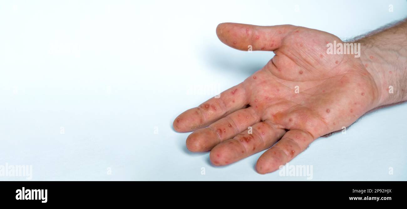 Mains de sexe masculin avec éruption de Monkeypox. Patient atteint de la maladie virale de Monkeypox. Gros plan d'une éruption cutanée douloureuse, des taches rouges apparaissent sur la peau. Palmier humain et santé Banque D'Images Mains de sexe masculin avec éruption de Monkeypox. Patient atteint de la maladie virale de Monkeypox. Gros plan d'une éruption cutanée douloureuse, des taches rouges apparaissent sur la peau. Palmier humain et santé Banque D'Images