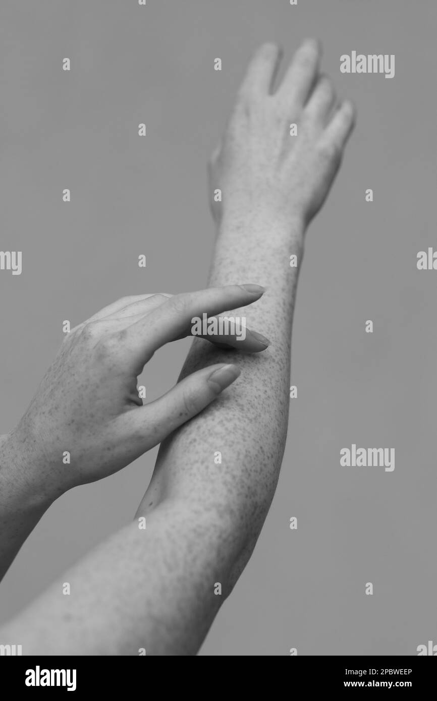 freckles sur les mains d'une belle fille Banque D'Images