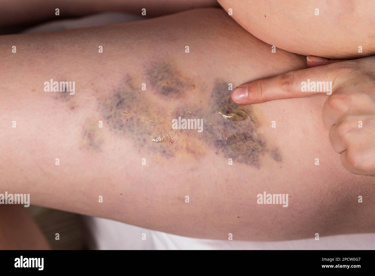 Traitement des ecchymoses, des bosses et des joints après injections avec pommade thérapeutique. Frottement d'une pommade médicinale dans les sites d'injection et d'ecchymoses. Banque D'Images