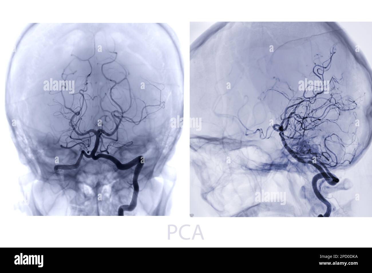 Cerebral arteriography Banque de photographies et d’images à haute ...