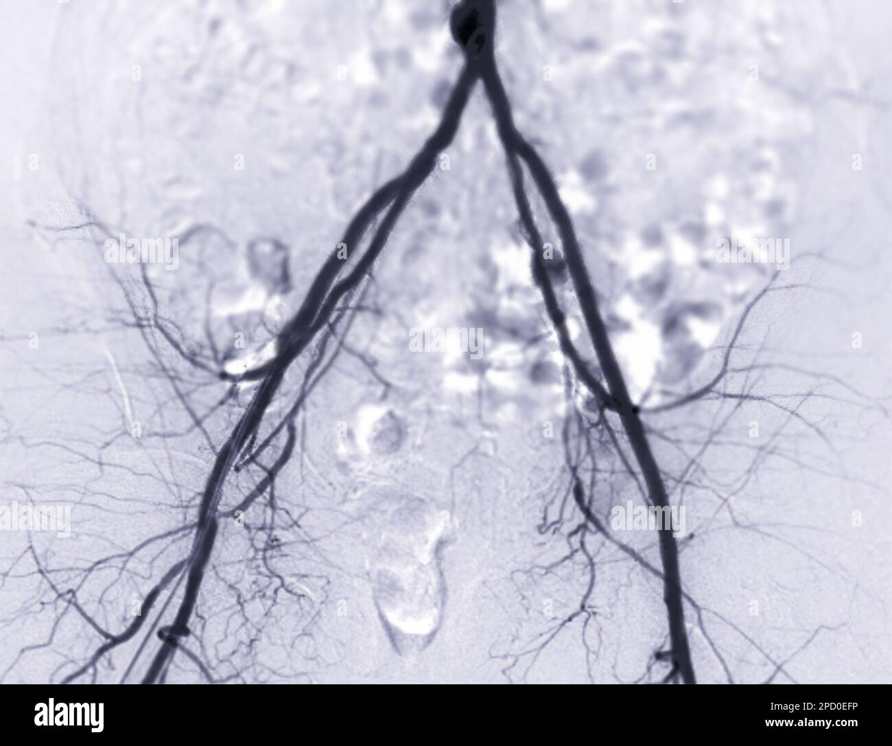 Angiographie ou angiographie de l'artère fémorale Banque D'Images