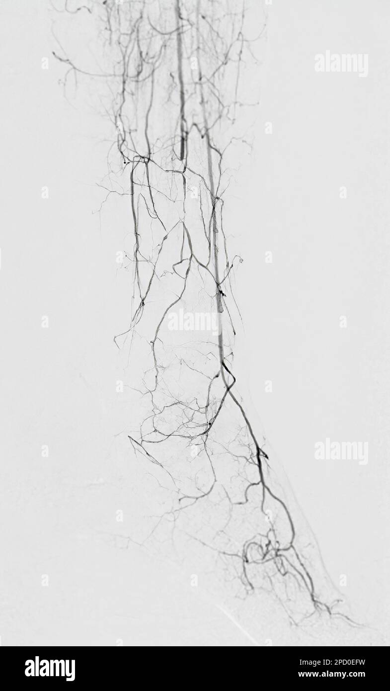 Angiographie ou angiographie de l'artère fémorale dans la zone des membres inférieurs. Banque D'Images