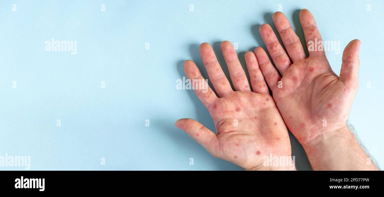 Mains de sexe masculin avec éruption de Monkeypox. Patient atteint de la maladie virale de Monkeypox. Gros plan d'une éruption cutanée douloureuse, des taches rouges apparaissent sur la peau. Palmier humain et santé Banque D'Images Mains de sexe masculin avec éruption de Monkeypox. Patient atteint de la maladie virale de Monkeypox. Gros plan d'une éruption cutanée douloureuse, des taches rouges apparaissent sur la peau. Palmier humain et santé Banque D'Images