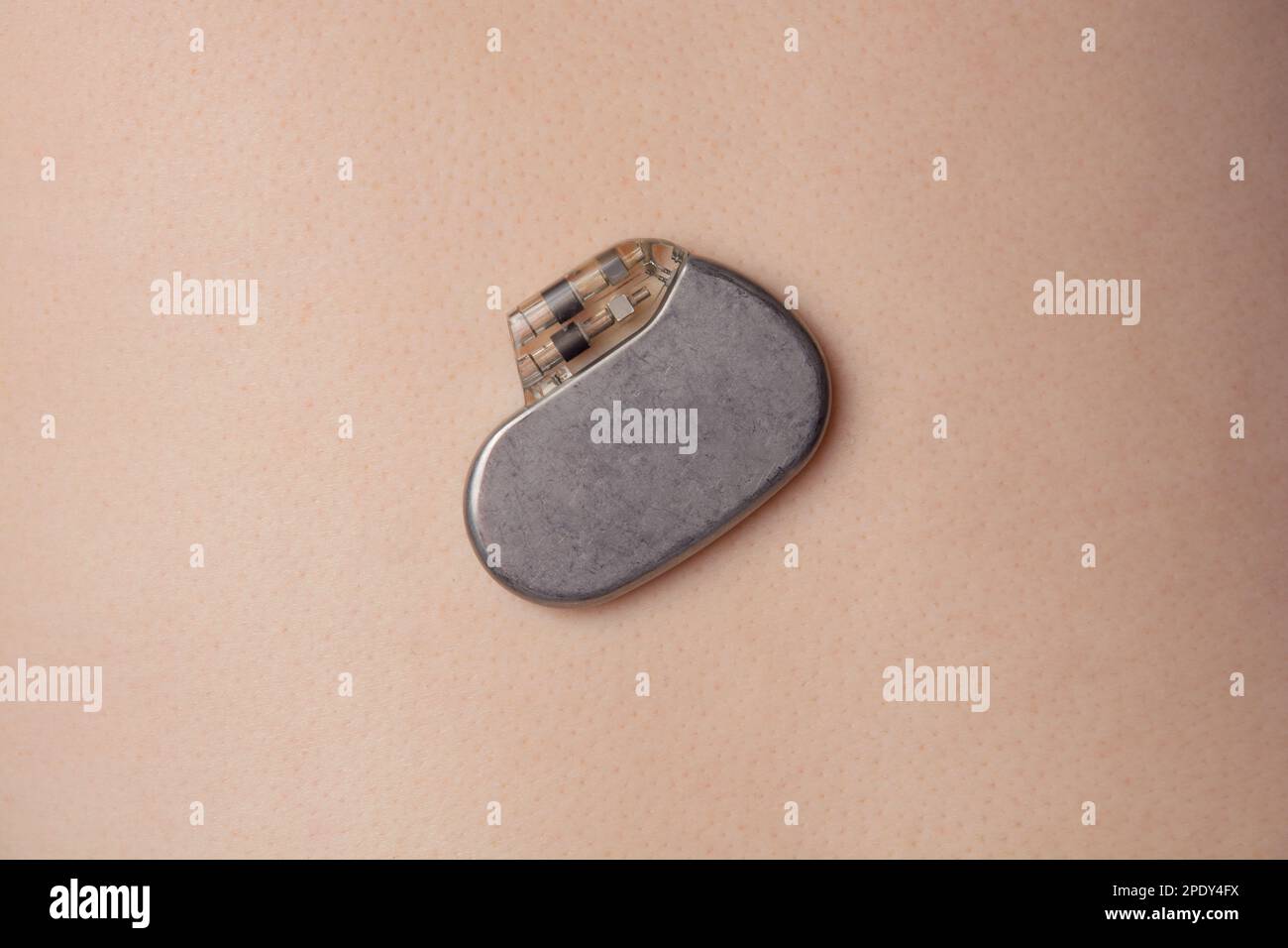 stimulateur cardiaque sur la surface de la peau Banque D'Images