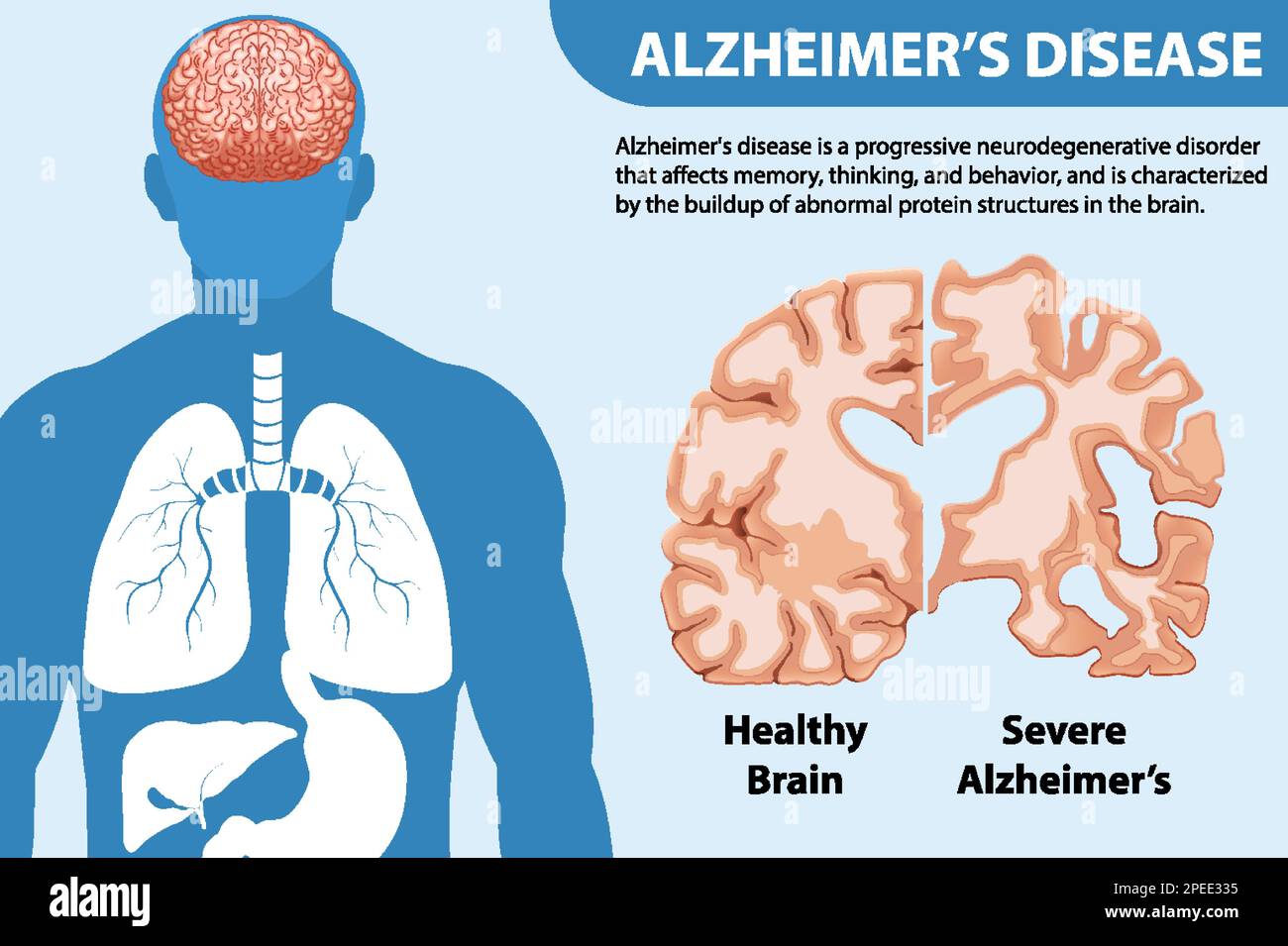 Pathologie de la maladie d'alzheimer Banque de photographies et d ...
