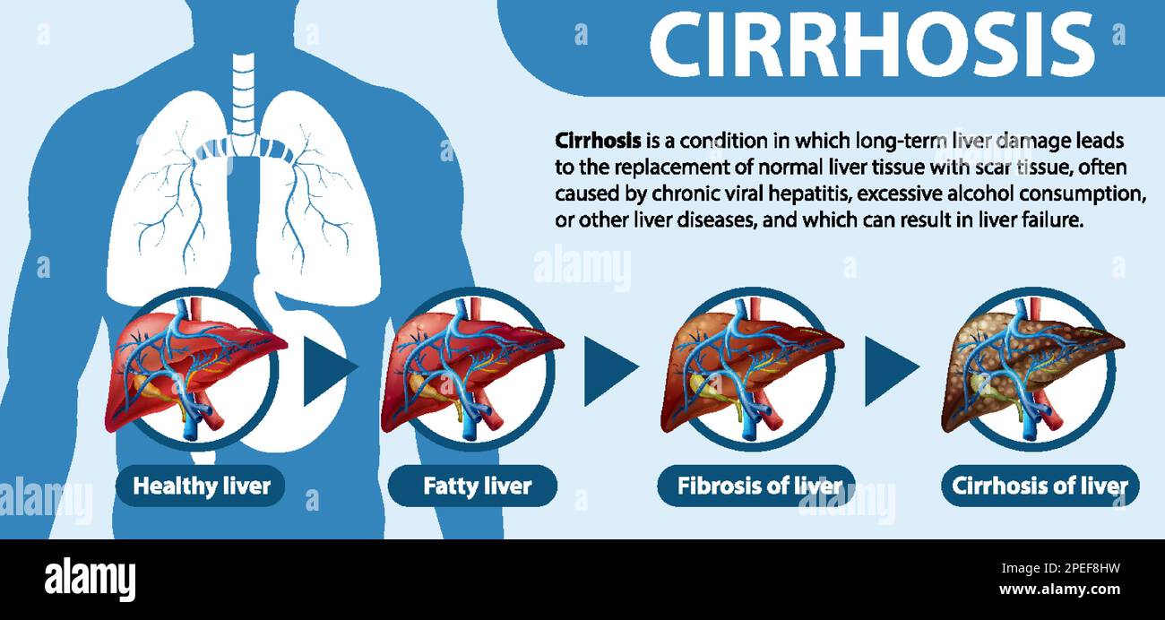Affiche informative sur l'illustration de la cirrhose alcoolique du foie Illustration de Vecteur