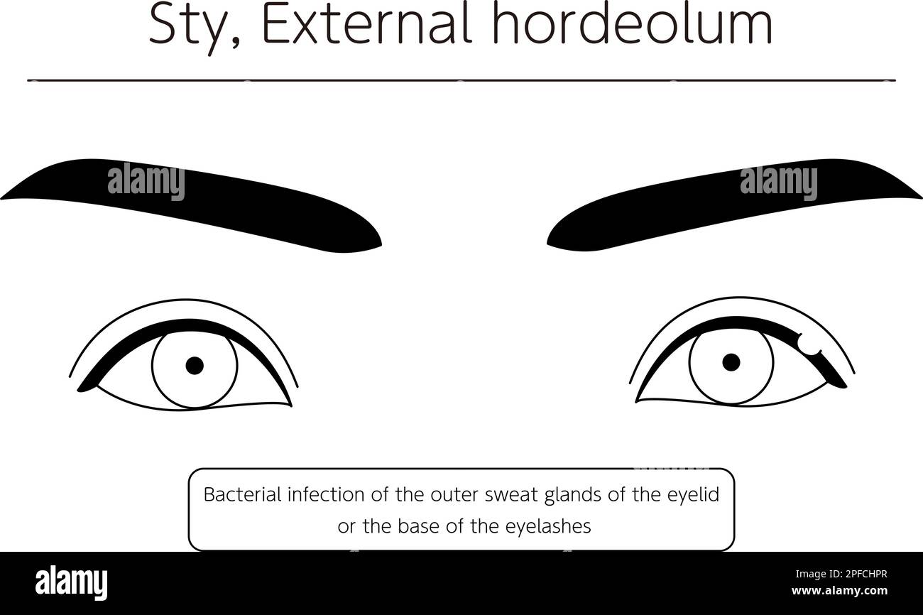 Medical Clipart, Line Drawing Illustration of Eye Disease and Sty, hordeolum externe, Vector Illustration Illustration de Vecteur