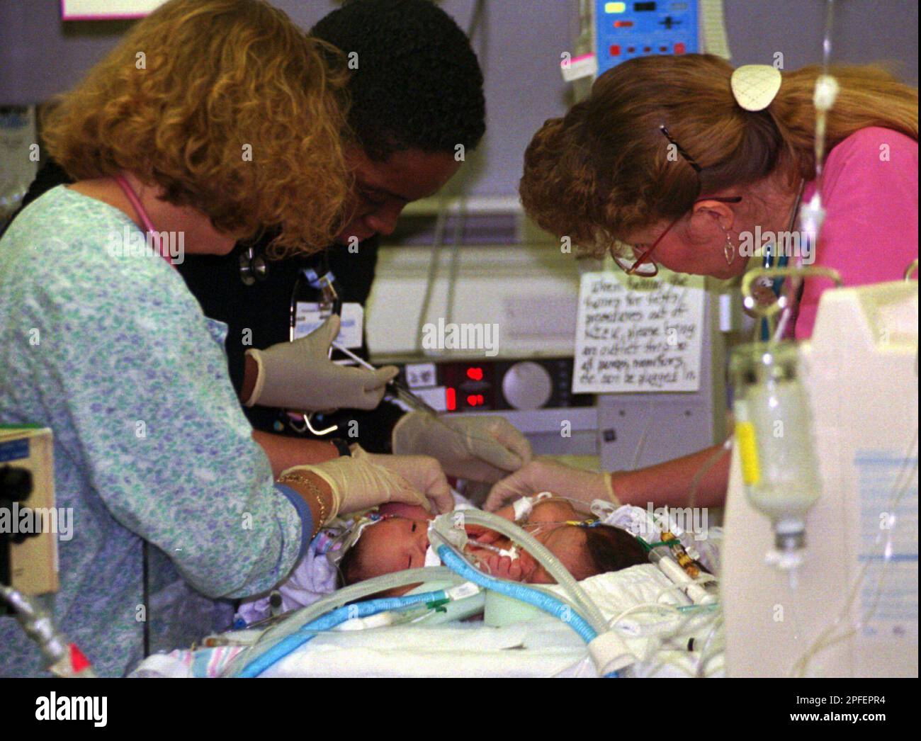 Nurses treat Siamese twins, Sarah and Sarahi Morales, Monday Jan. 22, 1996 at Childrens Hospital in San Diego. The girls were born on January 12, 1996 in Tijuana, Mexico. Doctors will perform a cardiac catheterization that will help decide the feasibility of separating the two girls. (AP Photo/Joan C. Fahrenthold) Banque D'Images