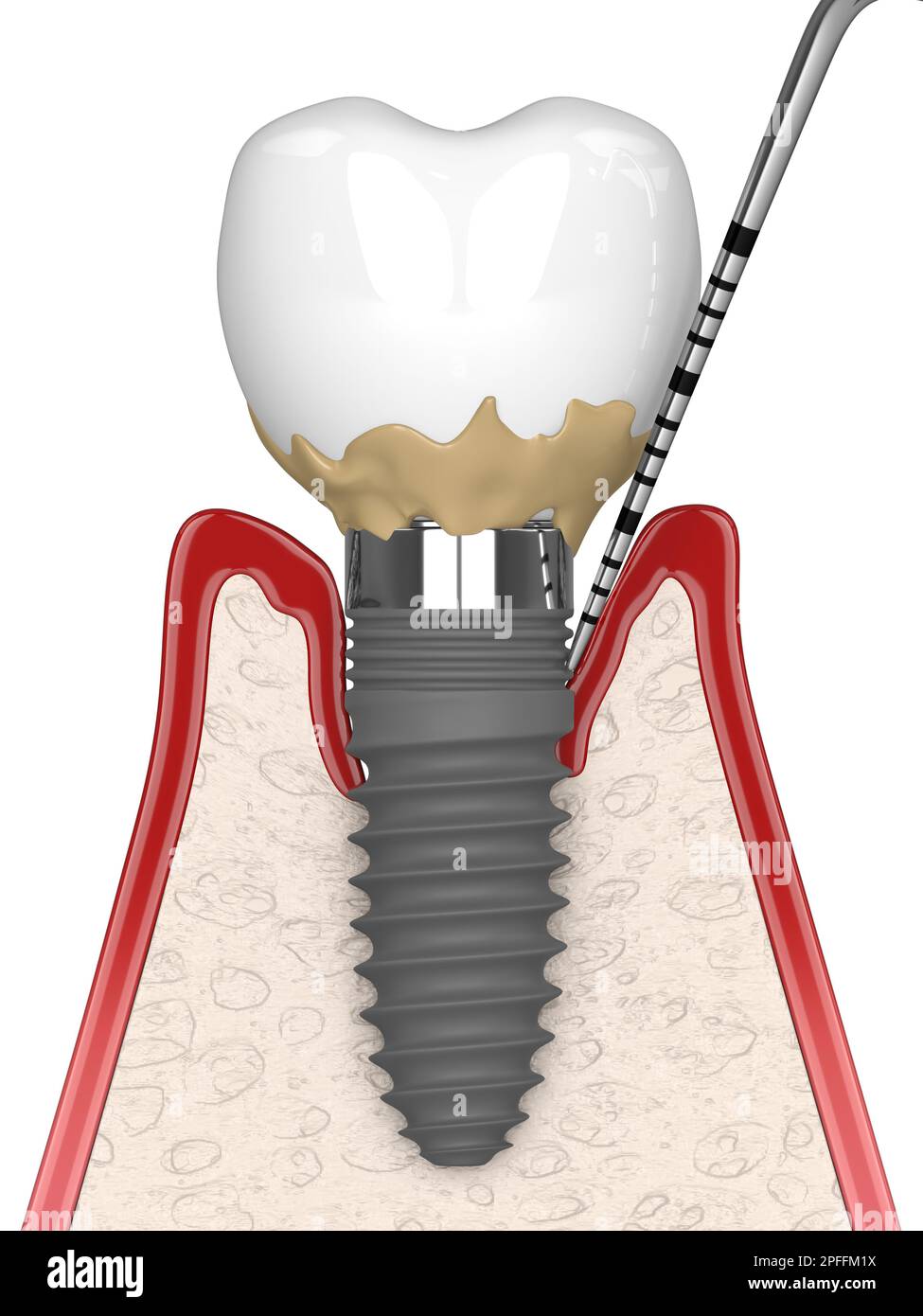 3d rendu de la coupe transversale des gencives humaines avec la périimplantite et la sonda parodontale sur fond blanc Banque D'Images