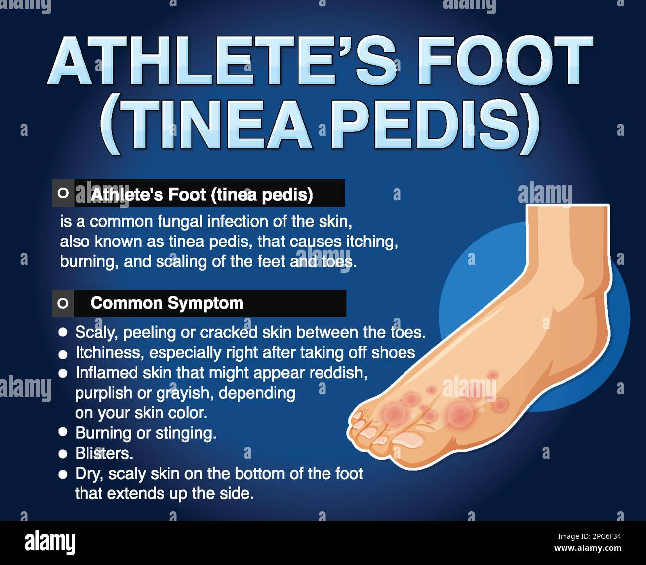 Affiche informative sur l'illustration du pied de l'athlète Illustration de Vecteur