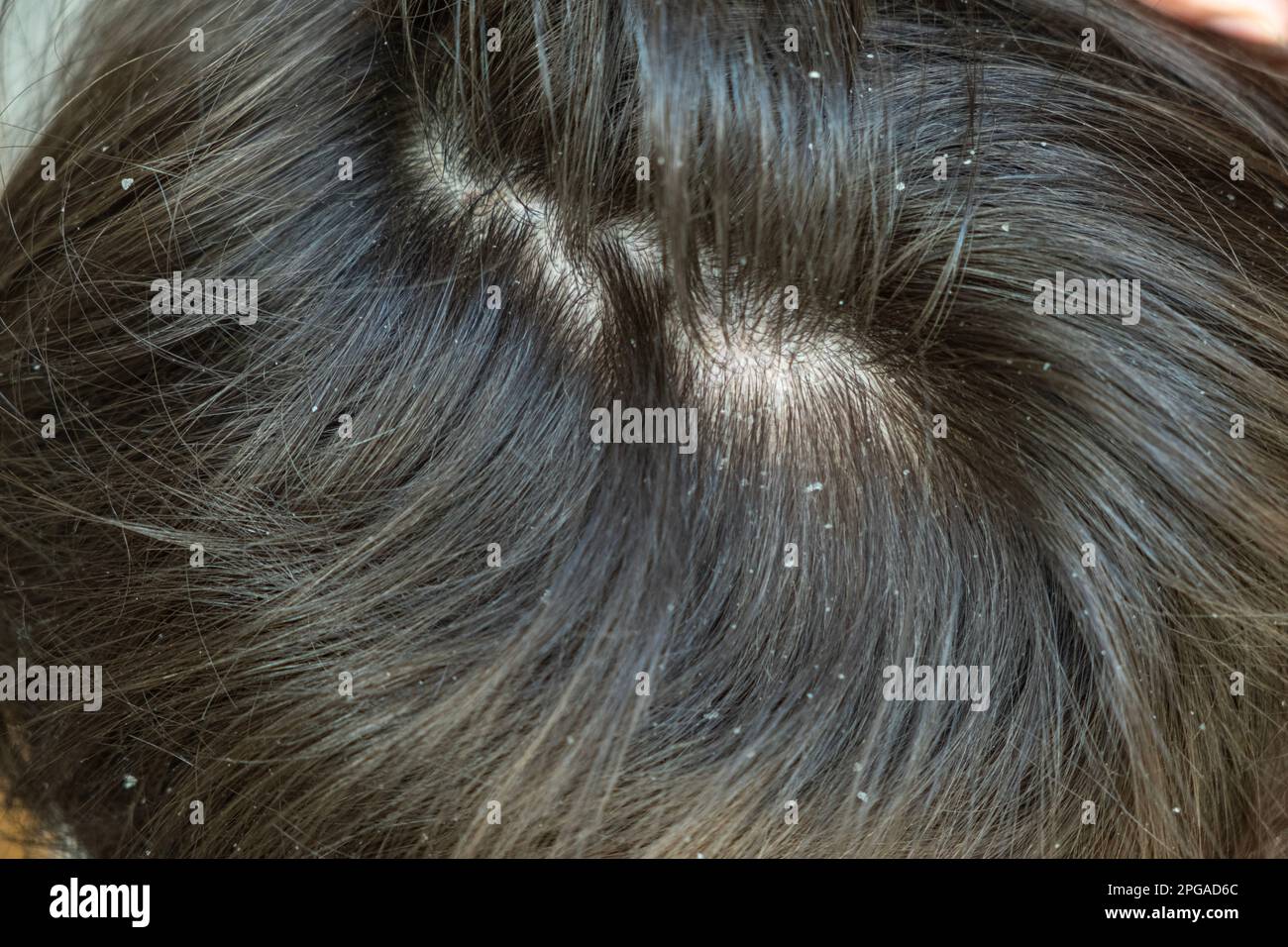 Pellicules dans les cheveux d'enfant. Cuir chevelu fragile. Pellicules pour enfants. Dermatite