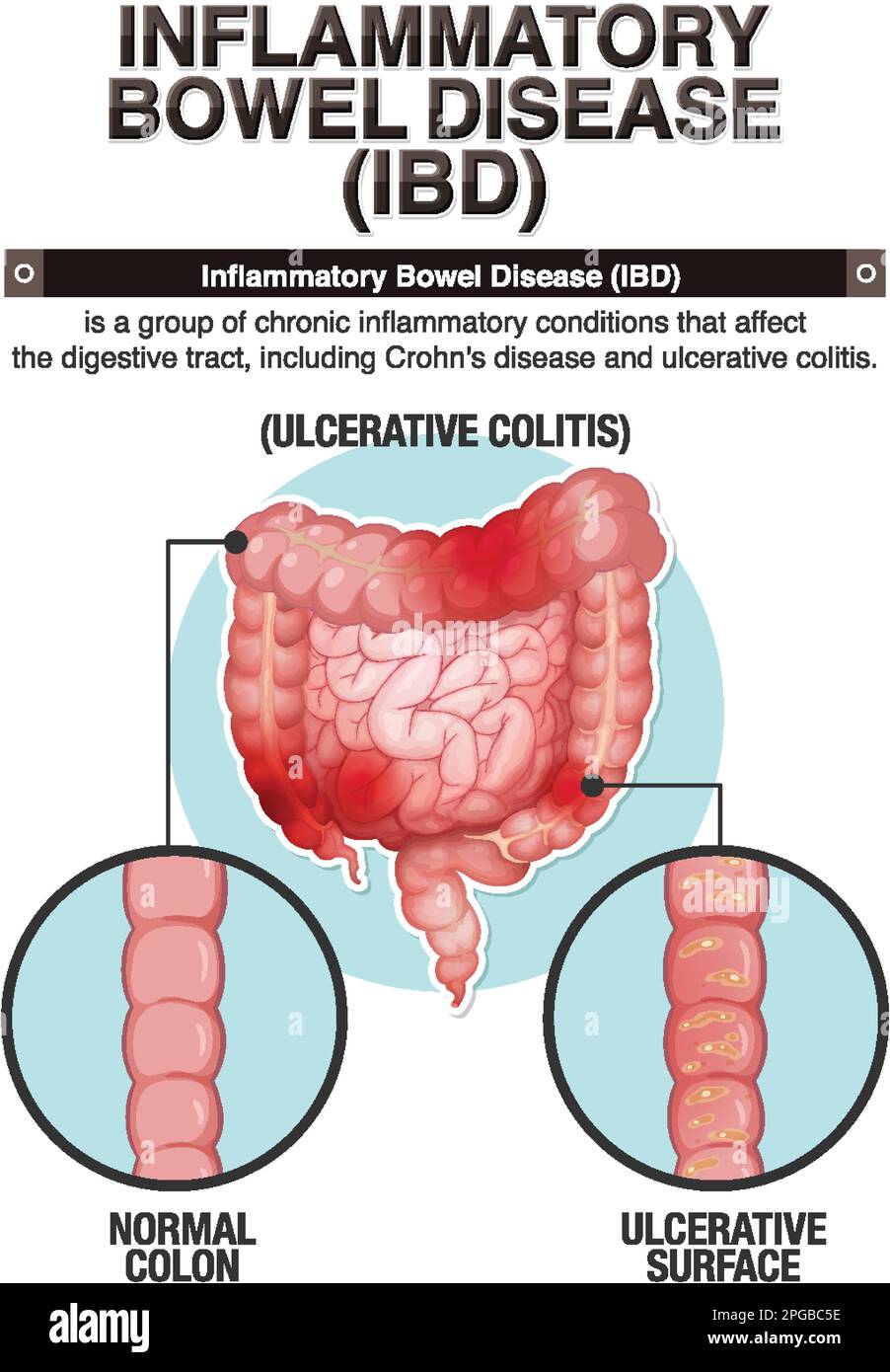 Illustration infographique des maladies inflammatoires de l'intestin (MII) Illustration de Vecteur