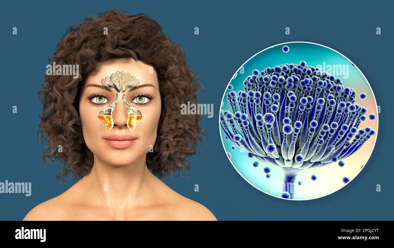 Aspergillus champignons comme une cause de sinusite. Illustration ...