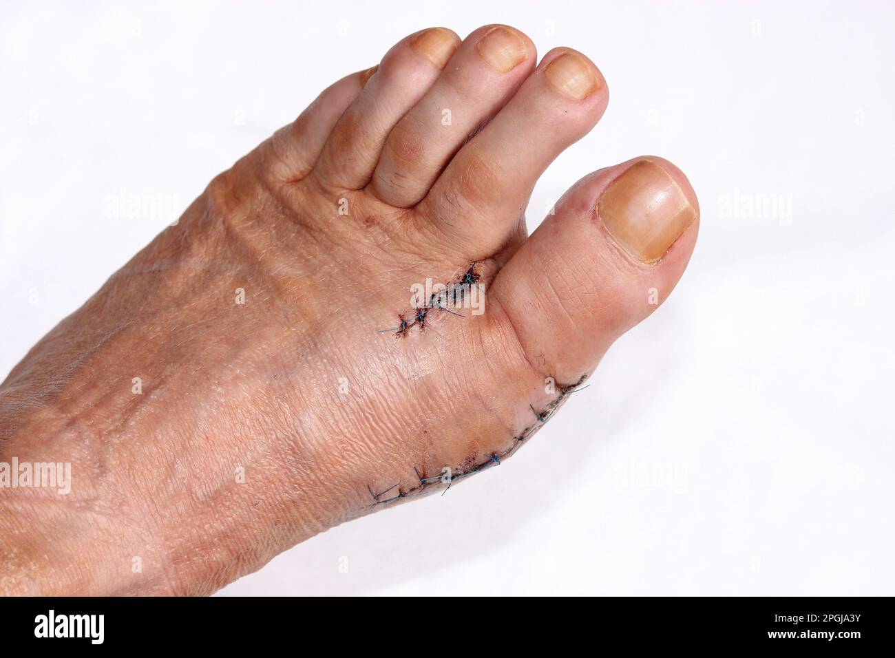 Hallux valgus, pied après chirurgie Banque D'Images