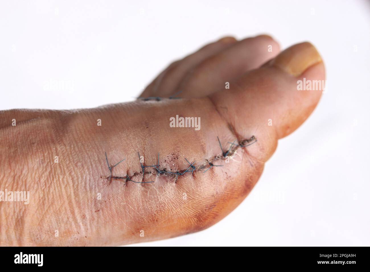 Hallux valgus, pied après chirurgie Banque D'Images