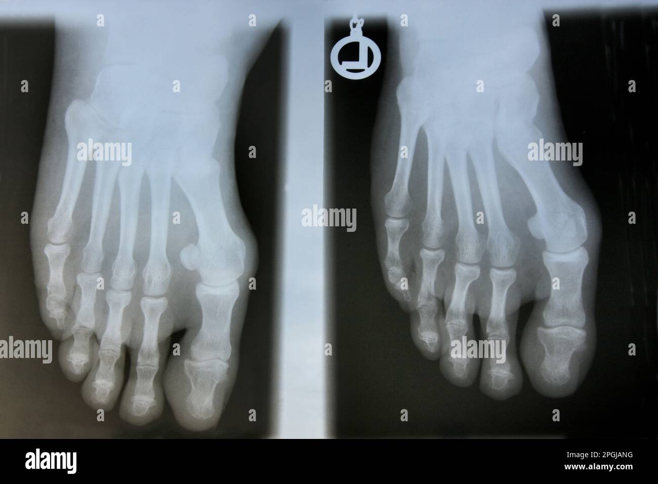 Hallux valgus, rayons X avant chirurgie Banque D'Images