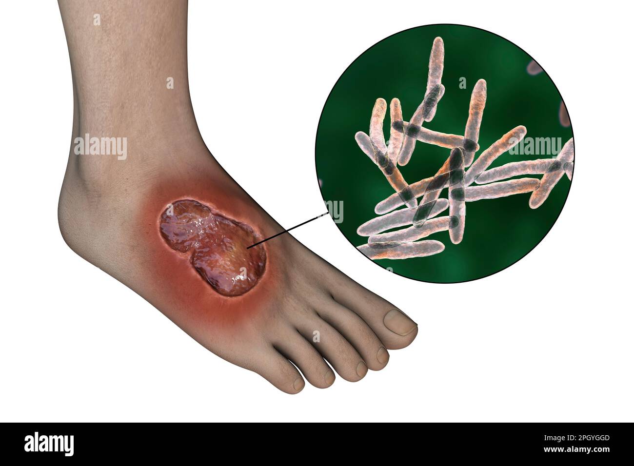 Ulcère de Buruli et Mycobacterium ulcerans, illustration Banque D'Images