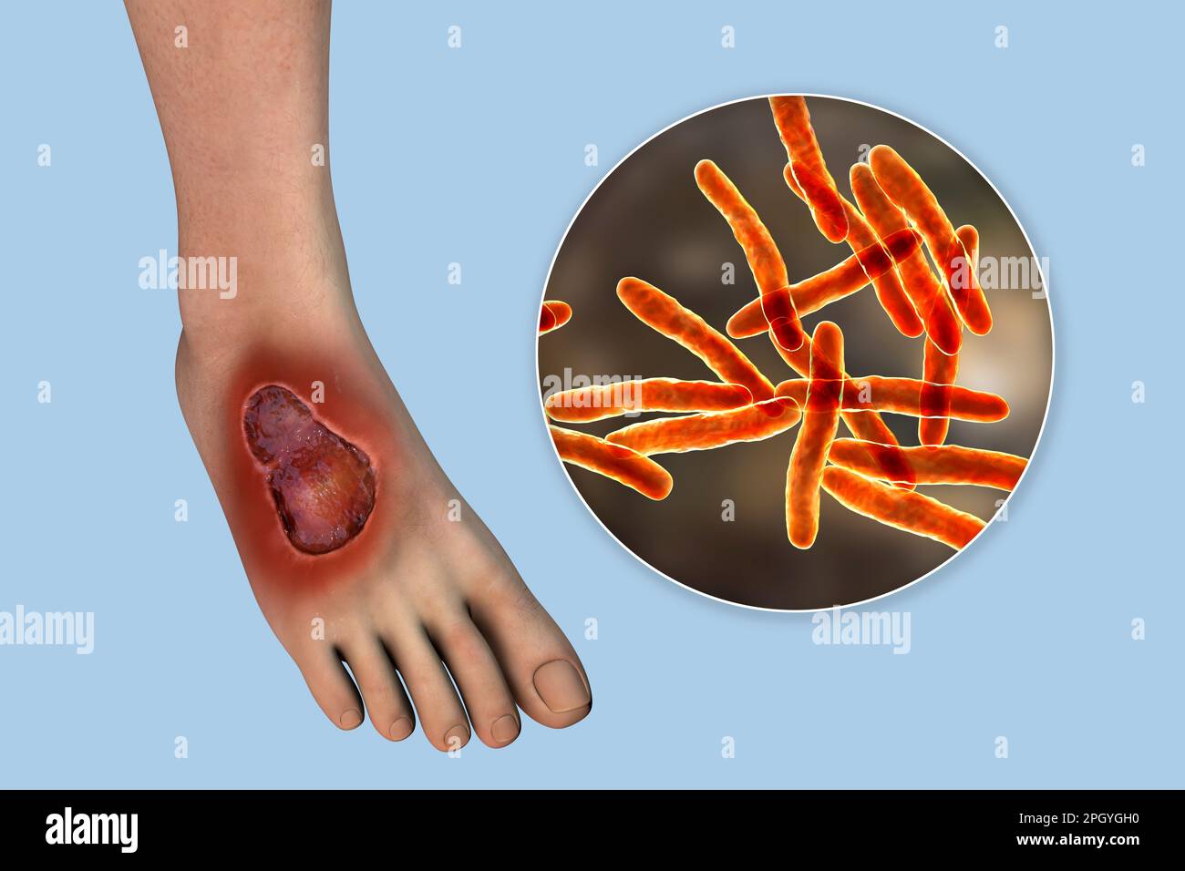 Ulcère de Buruli et Mycobacterium ulcerans, illustration Banque D'Images