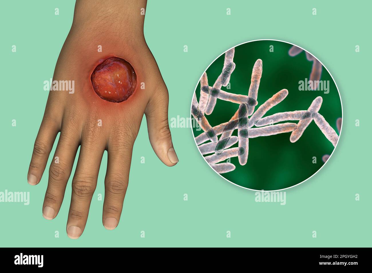 Ulcère de Buruli et Mycobacterium ulcerans, illustration Banque D'Images