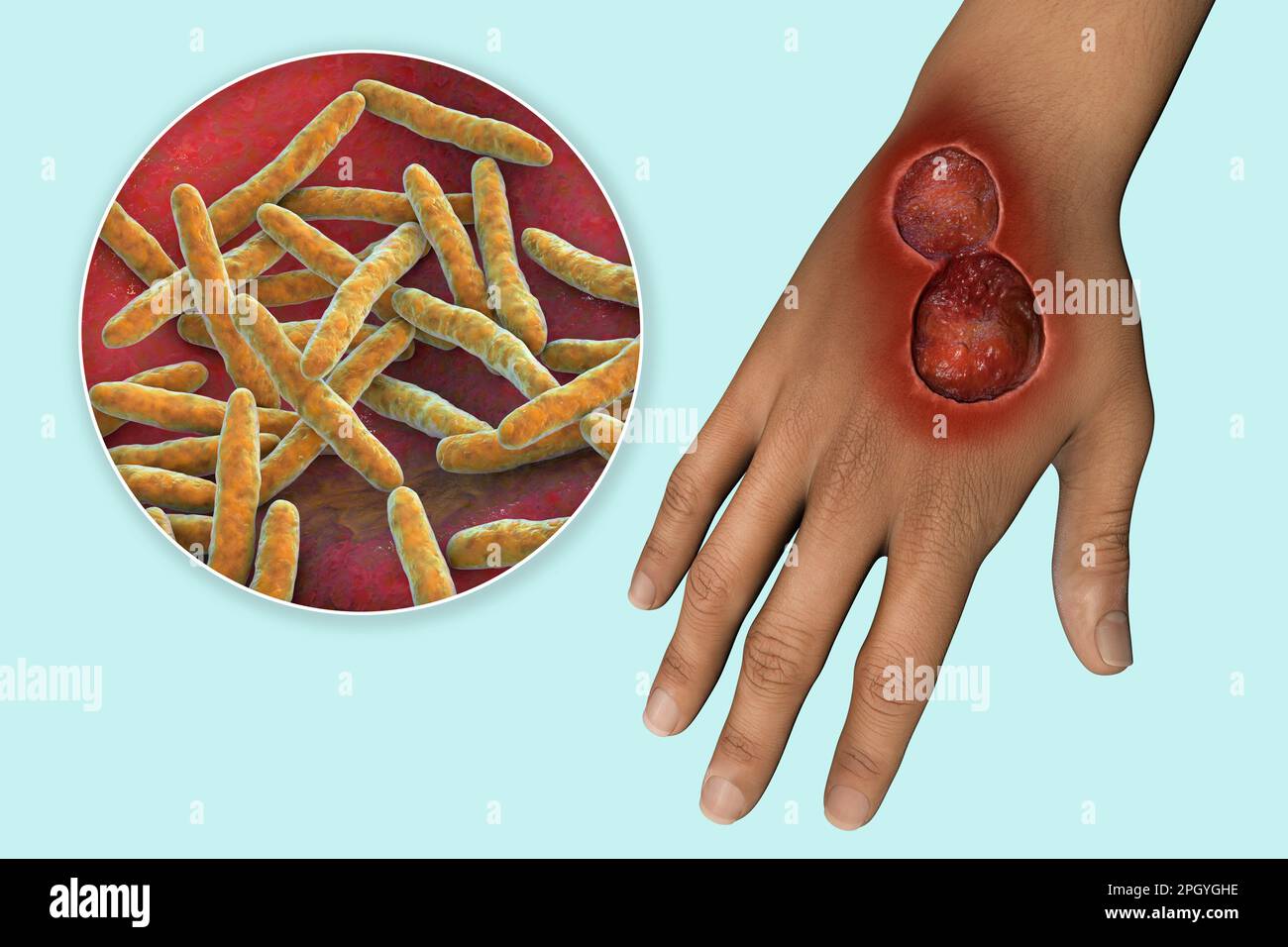 Ulcère de Buruli et Mycobacterium ulcerans, illustration Banque D'Images