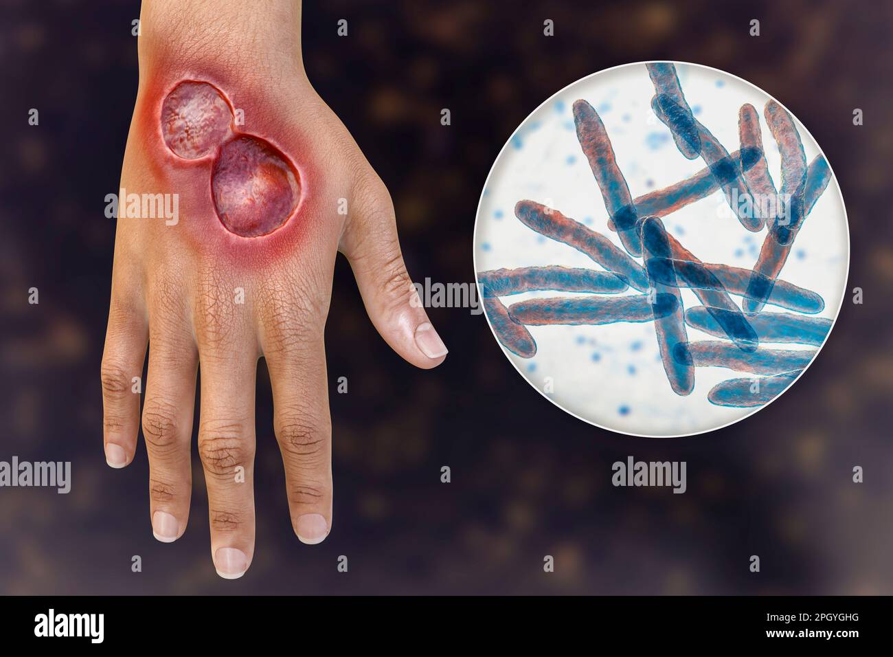 Ulcère de Buruli et Mycobacterium ulcerans, illustration Banque D'Images