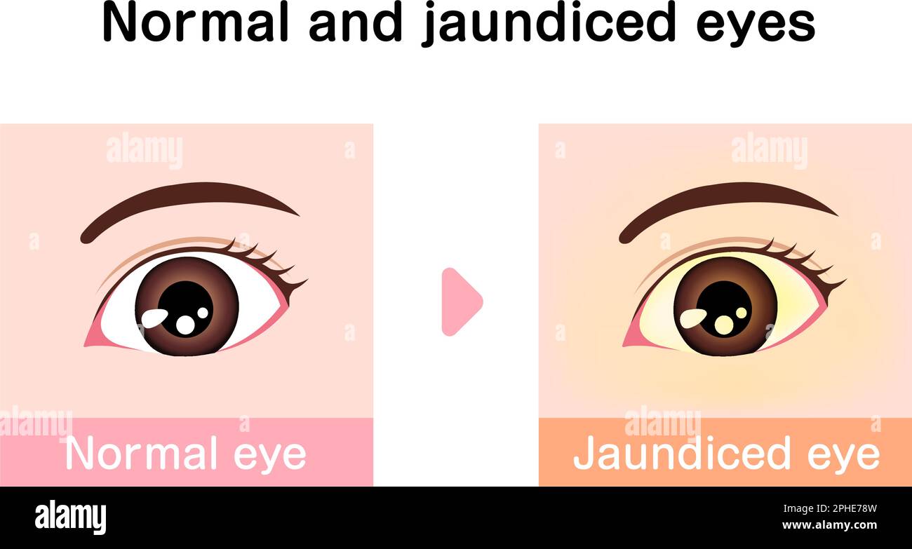 Illustration de comparaison des yeux normaux et jaundés Illustration de Vecteur